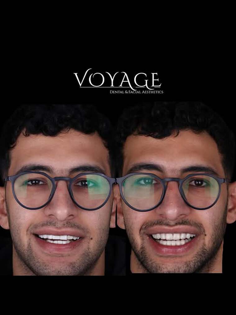 Full smile makeover shown before and after treatment, photographed in natural light