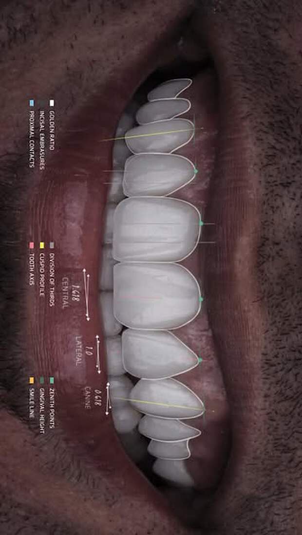 Digital Smile Design analysis overlaid on a patient's teeth, marking golden-ratio tooth widths, incisal embrasures, zenith points and the smile line